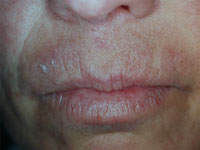 Dermatitis around lips due to contact with p-phenylenediamine