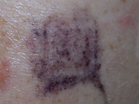 Negative patch test to p-phenylenediame