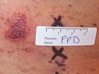 Positive patch test to p-phenylenediame